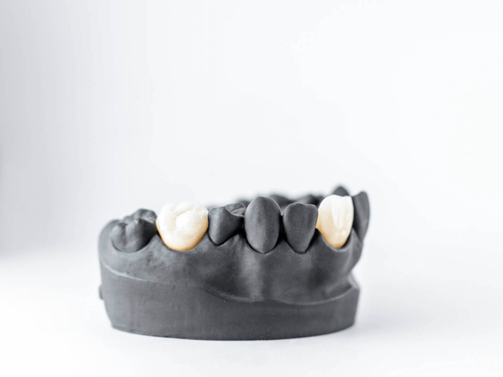 歯冠修復補綴物