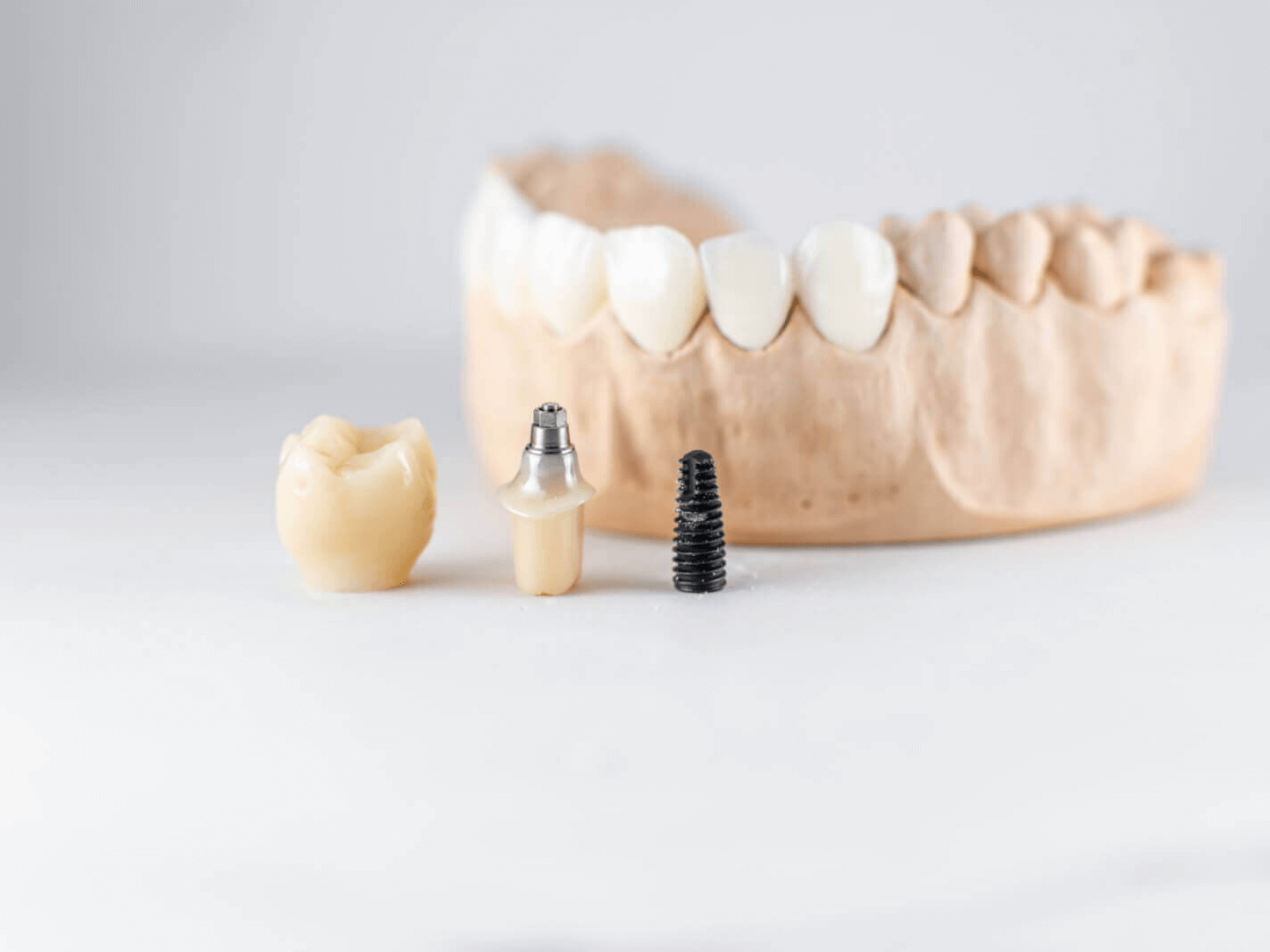 インプラント補綴物