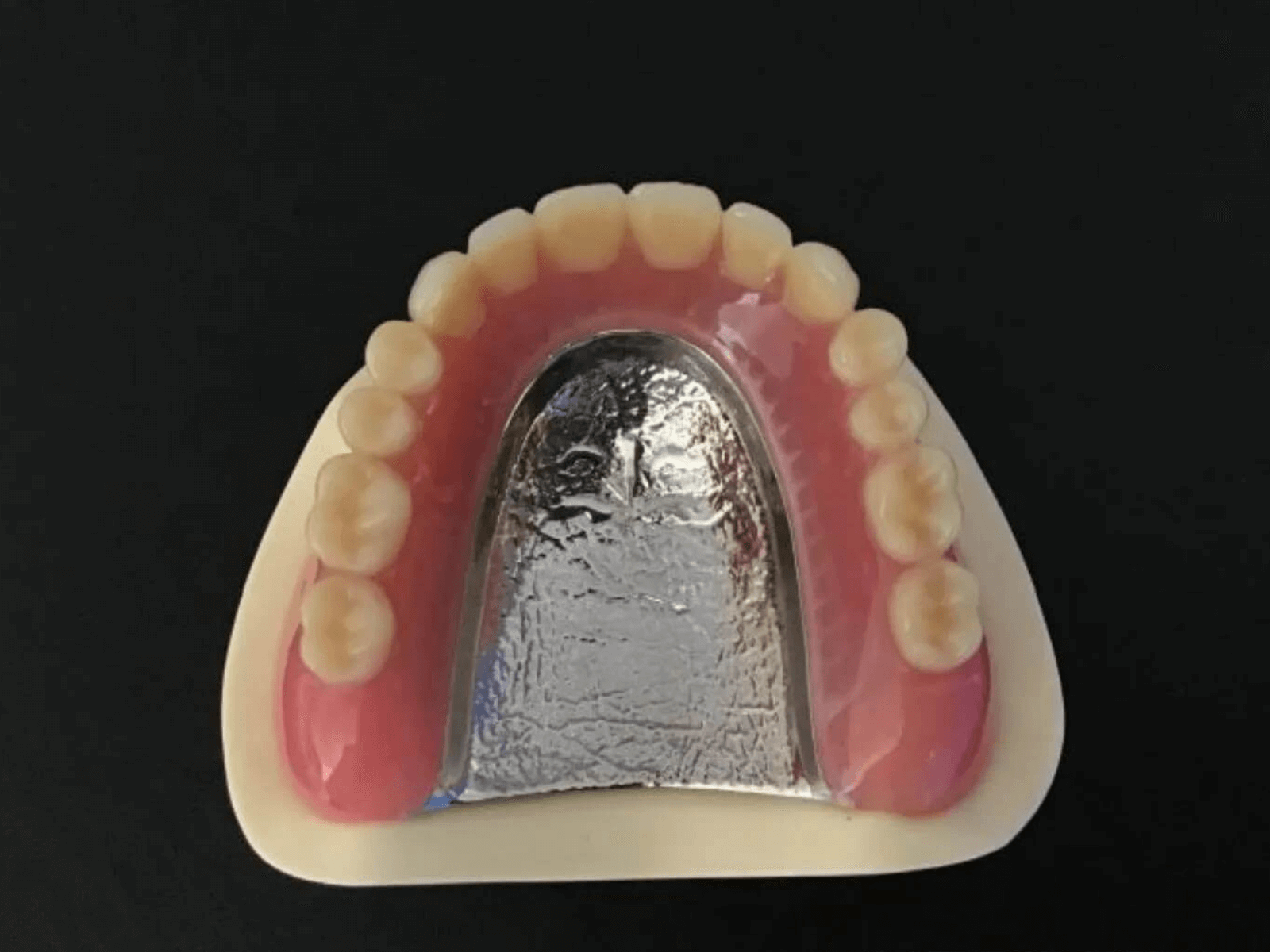 有床義歯補綴物