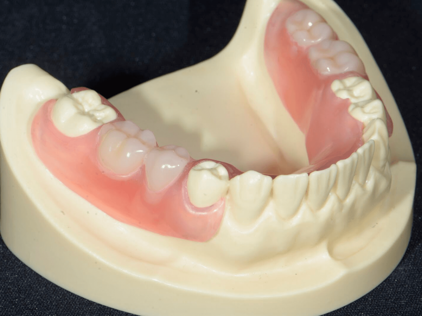 ノンクラスプデンチャー1